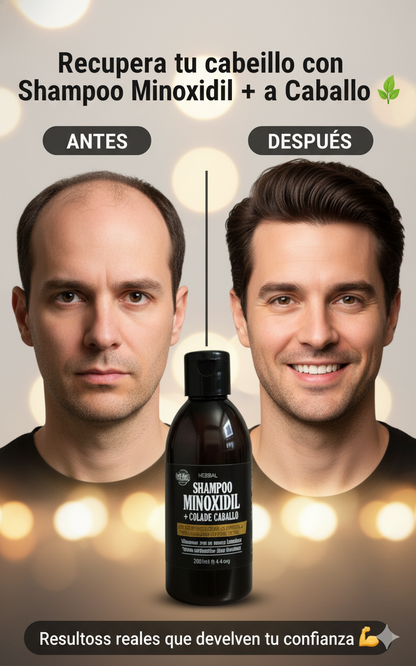 KIt shampoo minoxidil + aceite batana